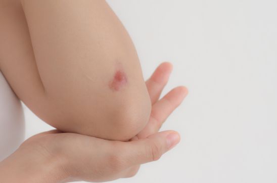 Types of Scars: How to Identify and Treat Each Scar Type