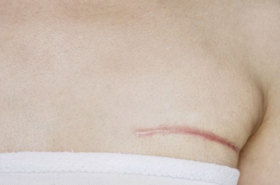 Breast Reduction Scars: What to Expect and How to Minimise Them