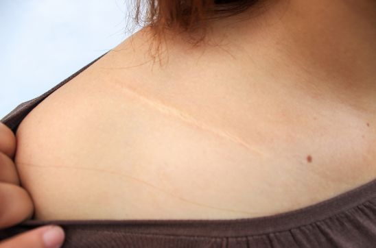 Shoulder Scar: Causes, Types & Treatment Options