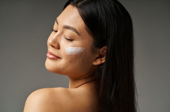 What is Acne-prone Skin? Meaning Explained