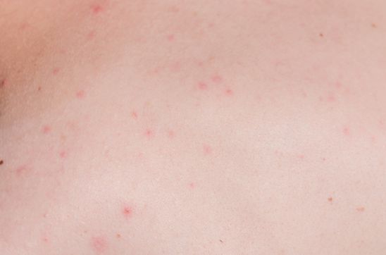 Butt Acne Scars: Why They Happen and How to Treat Them