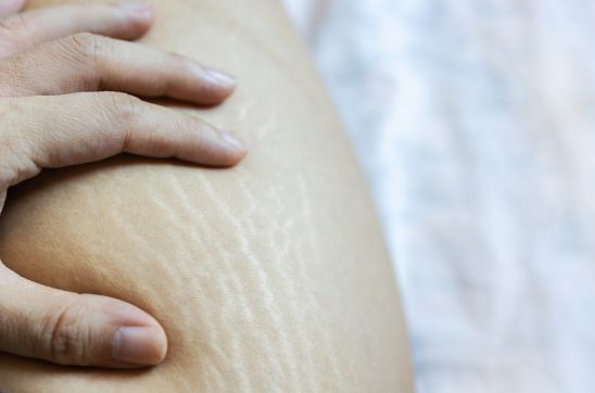 How Stretch Marks are Formed and How to Prevent Them