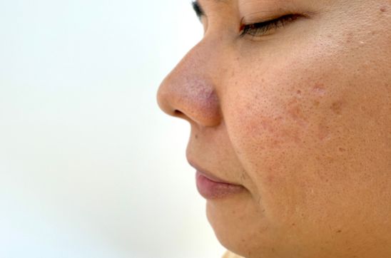 How Long Does it Take for Acne Marks to Go Away?